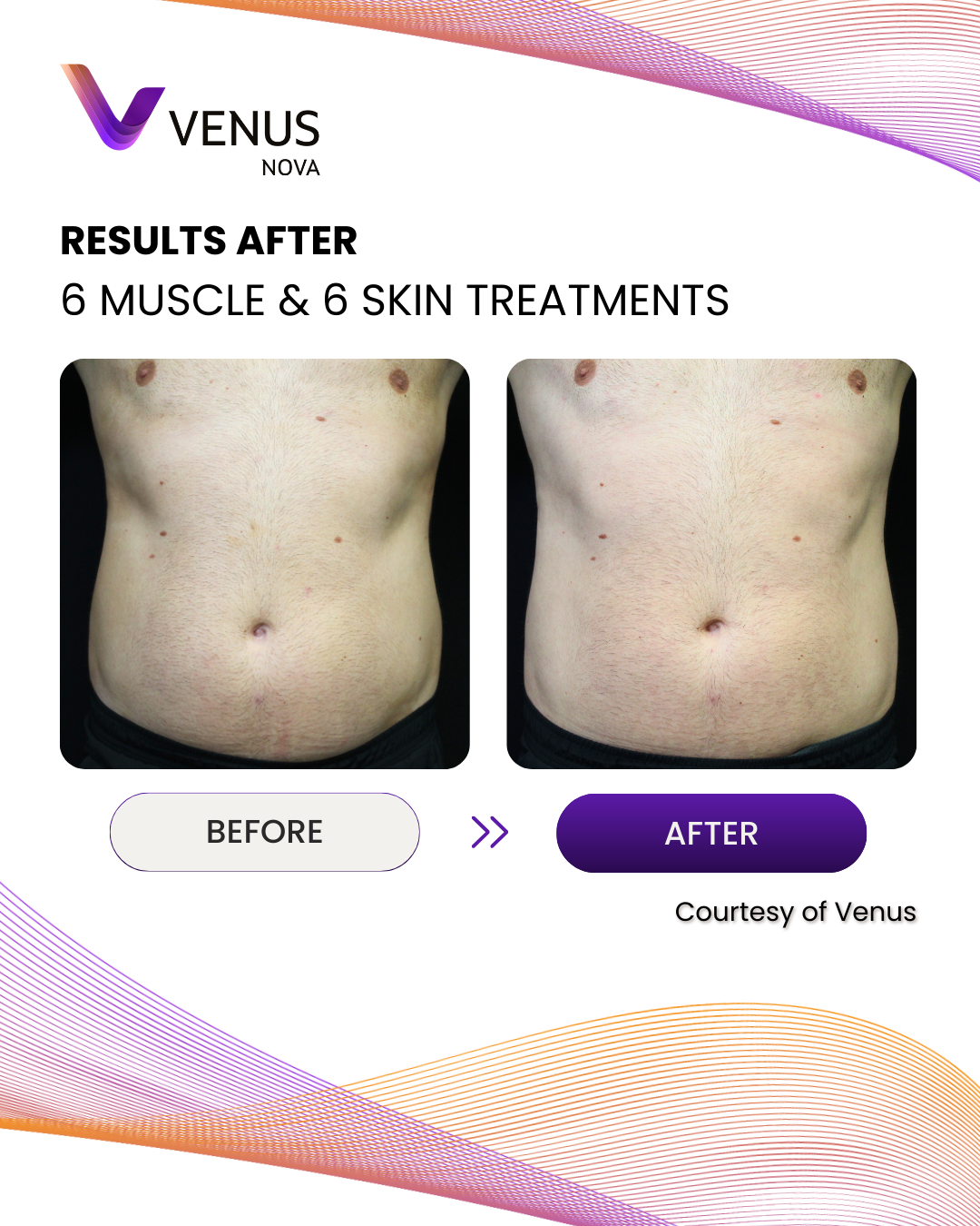 Nova 6 Muscle 6 Skin Venus 1
